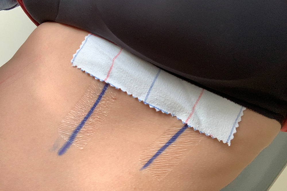 Der dritte und letzte Teil der Akuttherapie bei Brustkrebs: Die Bestrahlung! Oder auch: Und täglich grüßt die Strahlenabteilung! Mein Brustkrebs-Tagebuch. Elisabeth Steger von shesmile.