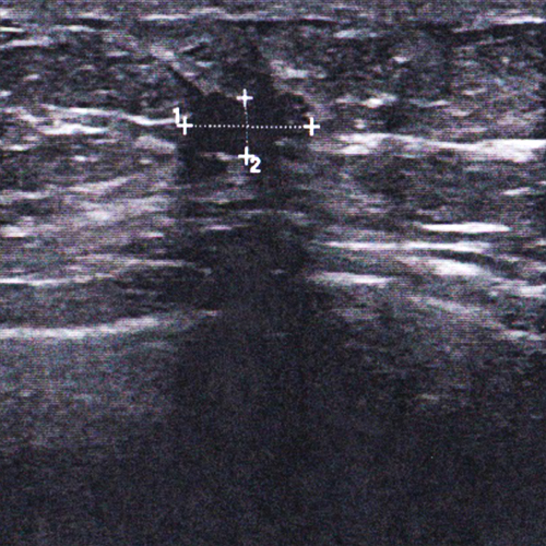 13. April 2021: Ultraschall nach der 2. EC - Der Tumor ist sichtbar kleiner geworden.