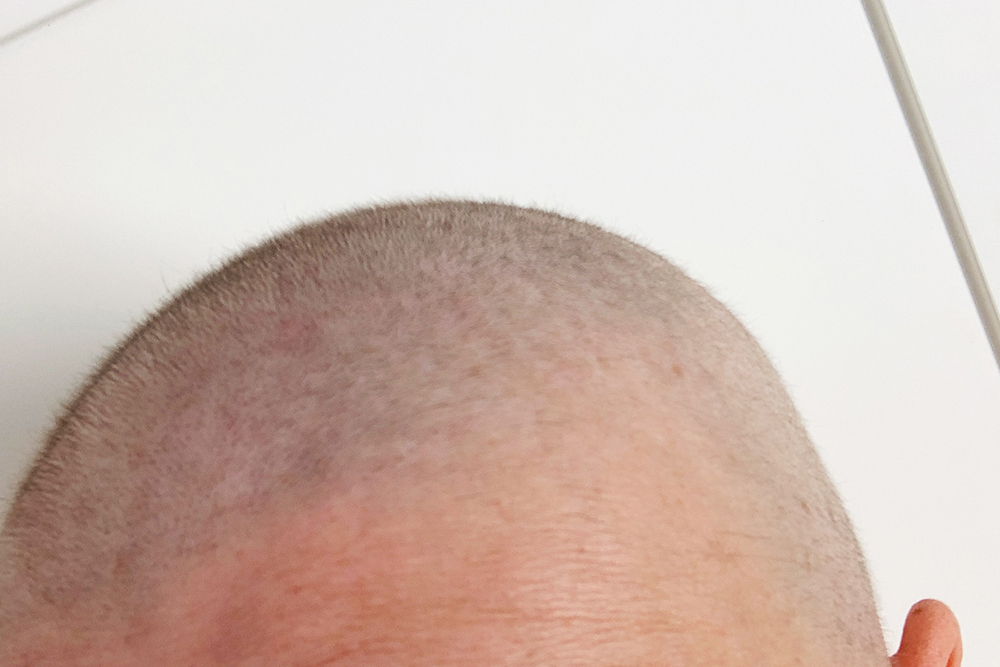 Ja, richtig gelesen die Haare am Kopf wachsen wieder. Ein kleiner Flaum ist schon zu sehen und meine Töchter freuen sich jeden Tag über jeden Millimeter. Augenbrauen und Wimpern sind allerdings noch kaum vorhanden.