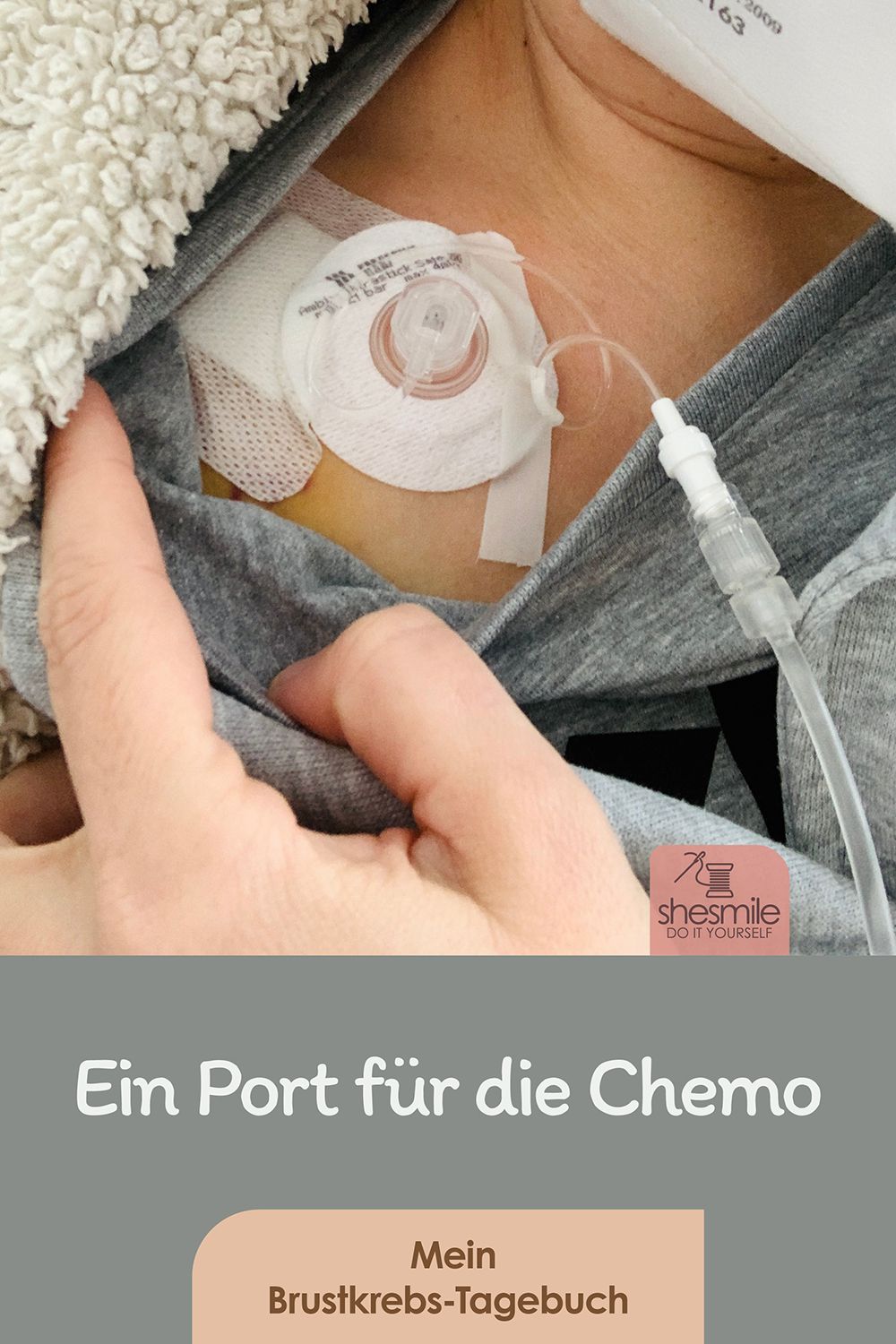 Die Port-OP vor der ersten Chemo